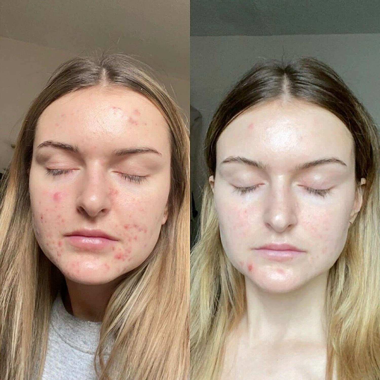 Retinol Gel 0.1 - 20 gm